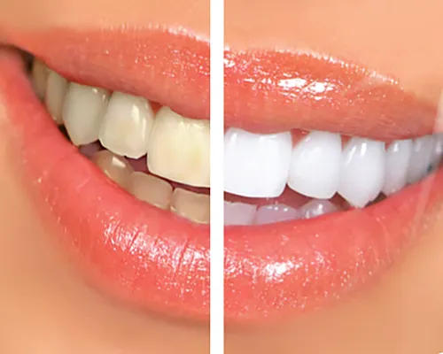 Before and After Teeth Whitening